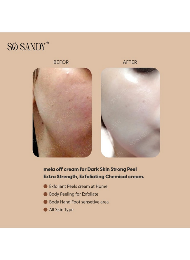 Mela Off Cream Cold Peel 5 gm - (one session)
